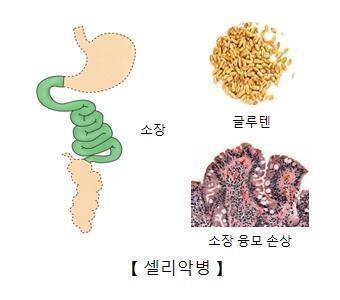 셀리악병 [출처: 서울아산병원]