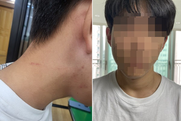 피해 학생 목에 남은 폭행 흔적(왼쪽)과 부어 오른 뺨의 모습. (사진=연합뉴스)