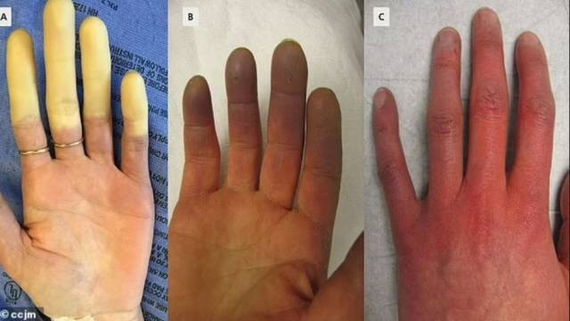 레이노 증후군에 걸리면 손발에 3단계 색깔 변화가 나타난다./사진=데일리메일 캡처