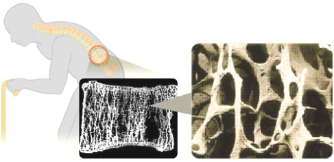 골다공증 환자의 뼈(출처=국가건강정보포털).