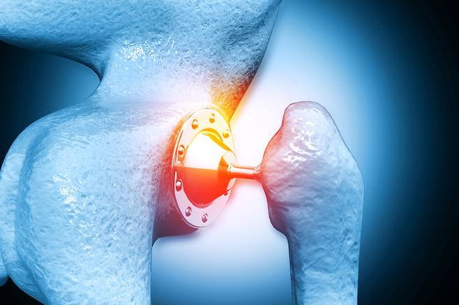 매년 수백만 명의 사람이 관절 교체 수술을 받는다. 이때 감염 예방을 위해 다양한 세균감염에 효과를 보이는 다목적 항생제 세파졸린이 투여된다. [사진= 게티이미지뱅크]