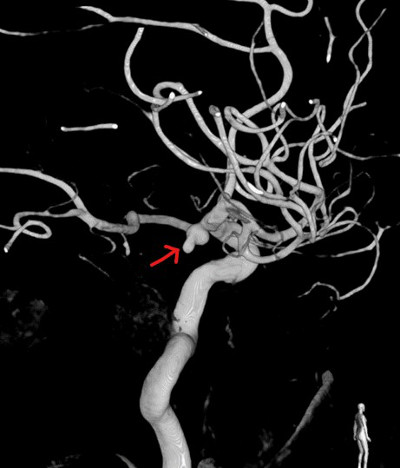 MRA(자기공명혈관조영술)영상에서 뇌혈관에 꽈리처럼 부풀어 오른 동맥류(빨간색 화살표)의 모습.