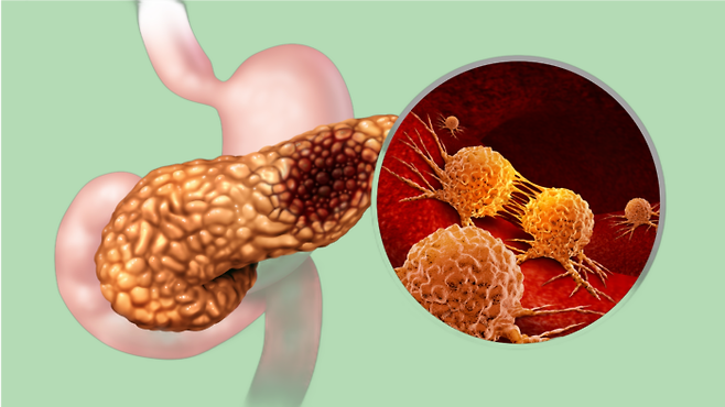 췌장암 모식도 [사진=게티이미지뱅크]