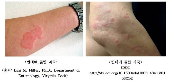 모기 물린 것과 비슷하나, 주로 옷에 가려지지 않은 팔·손·목·다리 등을 문다. 혈관을 잘 찾지 못해서 2~3곳을 연달아 물기도 한다. 질병청 제공