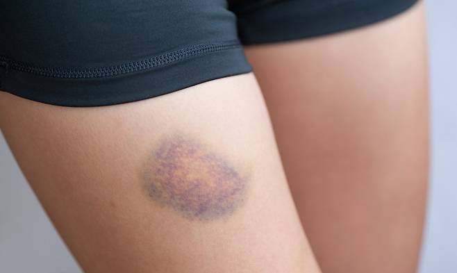 멍이 생기고 하루 뒤에는 달걀로 멍 부위를 문지르는 게 도움이 된다./사진=게티이미지뱅크