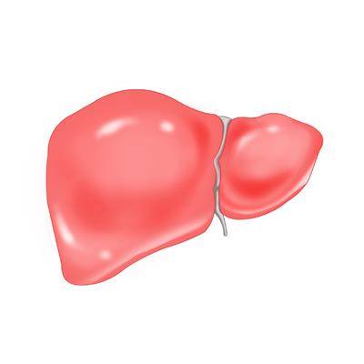 지방간 [출처: 삼성서울병원]