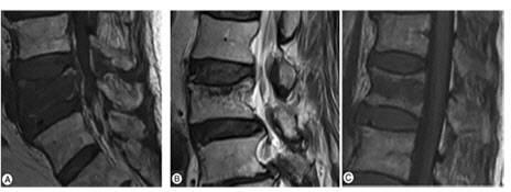 골다공증성 척추 골절 환자의 MRI 사진. A.확산형 타입, B.종판 타입 C. 중심부 타입.