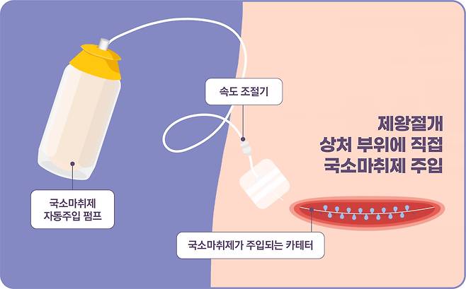 국소마취제가 수술 부위에 지속적으로 투여되는 과정. [이미지=코메디닷컴DB]