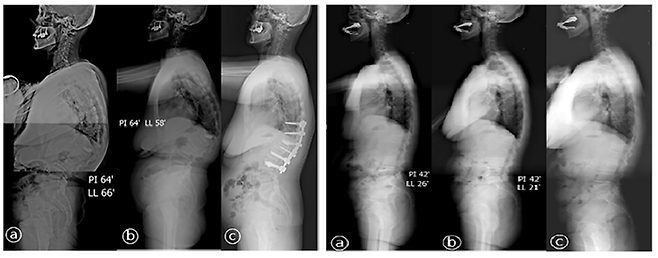수술적 치료가 필요했던 척추 골절 환자군인 제1군(왼쪽)에서는 척추뼈가 손실된 정도와 허리가 앞으로 굽는 초기 후만 변형이 심했으나, 보존적 치료만으로 치료된 제2군(오른쪽)에서는 상대적으로 초기 후만 변형이 적었다. 서울성모병원 제공