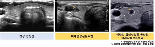 갑상선 초음파 비교 / 서울대병원 제공