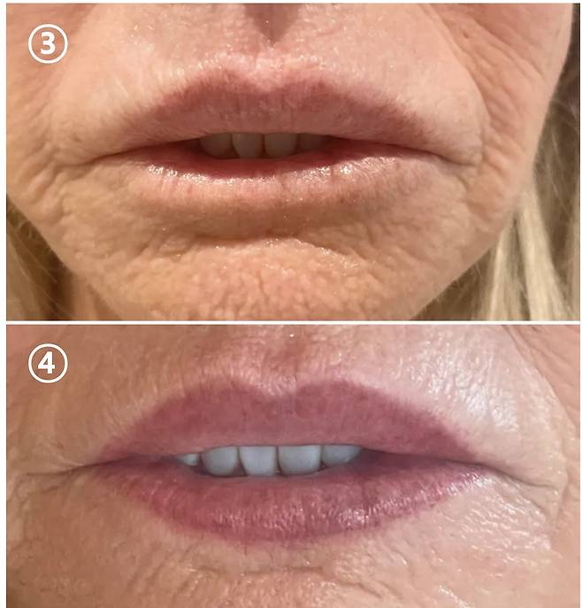 ③상단= 이후 폴린의 자가 유방에서 조직과 지방을 떼내어 입술이 두툼해질 수 있도록 모양을 잡았다. ④하단 = 입술라인과 입술 색을 넣는 타투를 받아 비교적 정상적 입술 모양을 갖추게 됐다. [사진=영국 일간 더선 보도내용 캡처_사진 재정리_코메디닷컴]