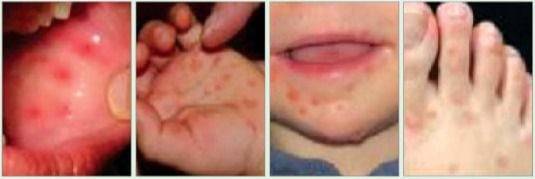 수족구병 환자의 물집/ 뉴스1