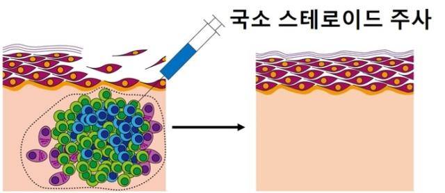 만성 재발성 천포창에 국소 스테로이드 주사 치료를 하기 전후 피부 병변 변화.강남세브란스병원 제공