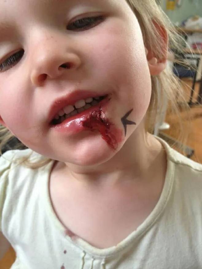 어릴 때 넘어져 입술이 찢어졌는데 통증을 못 느껴 부모에게 한참 뒤 발견된 올리비아 펀즈워스​의 모습./사진=더 선