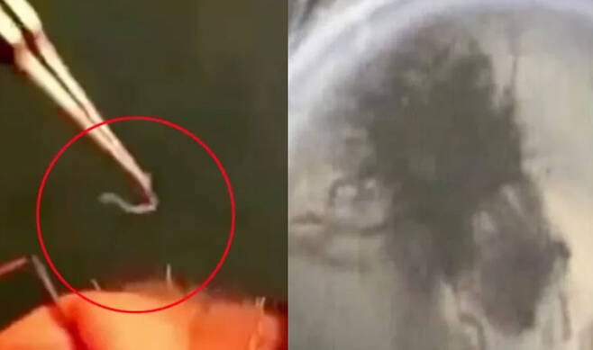 중국 쿤밍의 한 병원에서 의료진이 여성의 눈에 침투한 기생충을 제거하고 있다(왼쪽). 여성의 눈에서 나온 기생충. / 사진= 더 선