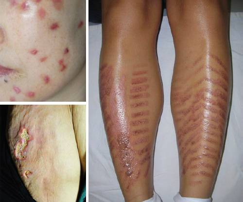 비의료인에 의한 레이저 시술로 발생한 흉터와 색소침착. 사진=대한피부과의사회 제공