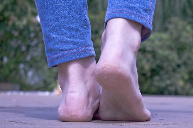 갈라지는 뒤꿈치에는 보습제가 아닌 무좀약이 더 필요할 수도 있다. 발 뒤꿈치 갈라짐은 각화형 무좀에 해당할 수 있기 때문이다. [사진=게티이미지뱅크]