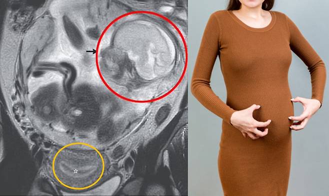 왼쪽 사진= 사연 여성의 스캔 사진. 별표가 있는 노란색 원 부위는 자궁이 비어 있음을 보여주며  빨간색 원 부위 화살표는 복막강에서 태아가 자라고 있음을 보여준다. [사진='데일리메일' 보도내용 캡처/ 우측사진=게티이미지뱅크 *임신 배 이해를 돕기 위함]