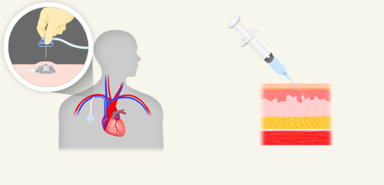 유방암 항암요법을 위한 약제 주사 방법으로는 체내에 케모포트를 삽입하는 정맥주사(왼쪽)를 주로 써왔으나 최근 피부 아래에 직접 주사하는 피하주사(오른쪽) 방식의 약제가 나오고 있다. 보건복지부 제공