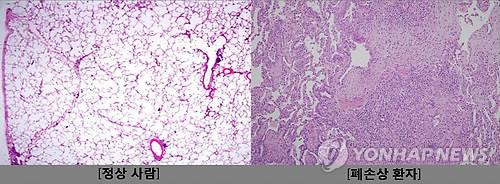 가습기살균제로 인한 폐 조직 손상비교 [질병관리본부 제공. 재판매 및 DB 금지]