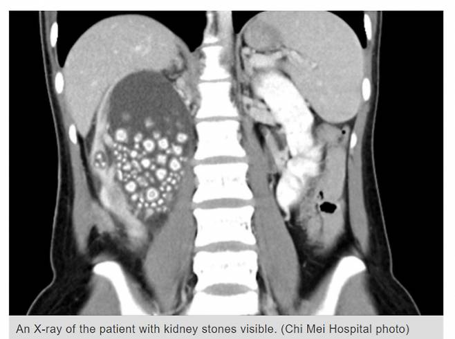 평소 물대신 주스나 차만 마신 타이완 여성의 몸에서 300개가 넘는 신장결석이 적출됐다. 사진은 해당 여성에게 생긴 신장 결석. /사진=타이완뉴스(치메이병원) 홈페이지