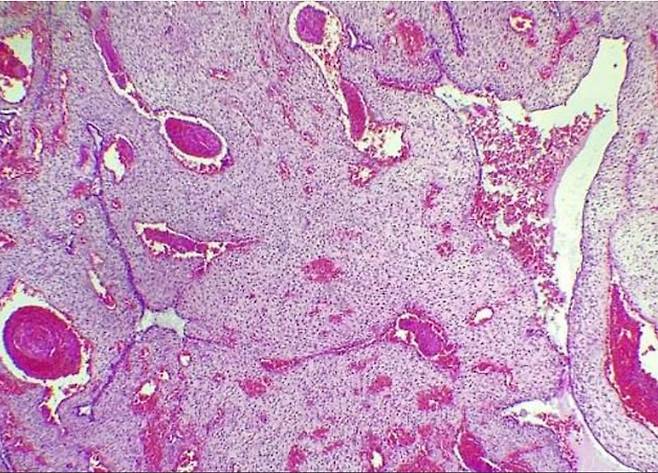 해당 환자의 자궁 내막 안에 혈관들이 확장되고 곳곳에 피가 고여 있는 스캔 이미지 [사진=American Journal of Case Reports]
