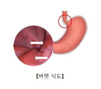 바렛 식도 [출처: 서울아산병원]