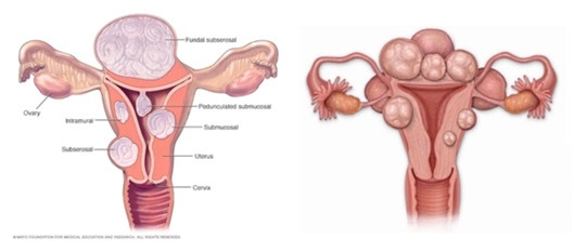 좌: 거대자궁근종 / 우: 다발성자궁근종｜출처: 최상산부인과