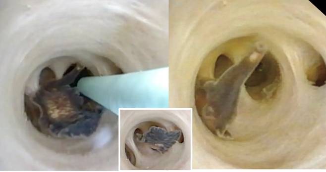 영화 '에일리언'에서 나올 법한 '괴생물체'가 70세 남성의 복부에서 발견됐다. 사과 속 벌레처럼 기생충이 꿈틀거리는 모습이다. [사진=뉴욕포스트 보도 캡처]