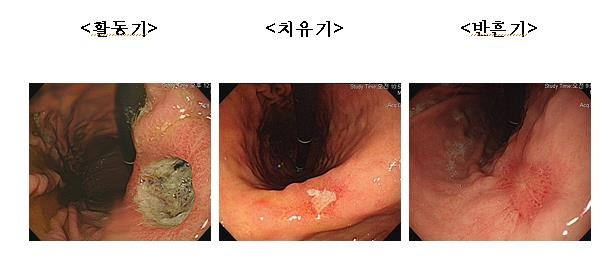 위궤양의 단계별 모습. 사진 제공=국민건강보험공단