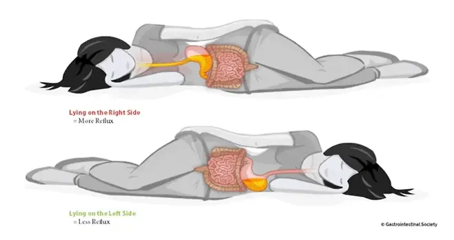 속쓰림이 심하면 오른쪽(위)보다 왼쪽(밑)으로 돌아눕는 게 위산 역류를 줄여 통증을 완화할 수 있다. [자료=Canadian Society of Intestinal Research]