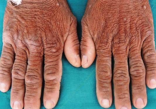 흑색가시세포증이 발생한 손등/사진=Tripe Palms and Acanthosis Nigricans: A Clue for Diagnosis of Advanced Pancreatic Adenocarcinoma(2019 Indian Dermatol Online J.