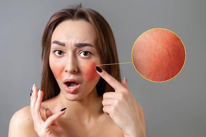 안면홍조증은 피부 진피 속에 있는 모세혈관이 지속적으로 늘어나 있는 상태를 말한다. [사진=게티이미지뱅크]