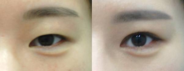 눈썹이 올라간 것이 아니라, 눈꺼풀 피부 때문에 눈썹을 치켜뜨고 있는 것입니다. 쌍꺼풀만으로 눈썹 위치는 편안해집니다.
