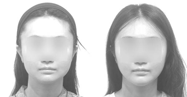 이마가 넓은 것이 아니라, 턱이 짧은 것입니다. 짧은 턱을 늘여주면 이마는 넓어 보이지 않게 됩니다.
