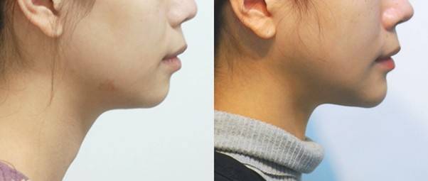 입이 나오고 목이 늘어진 것이 아니고, 턱 끝이 뒤로 빠진 것이 원인입니다.