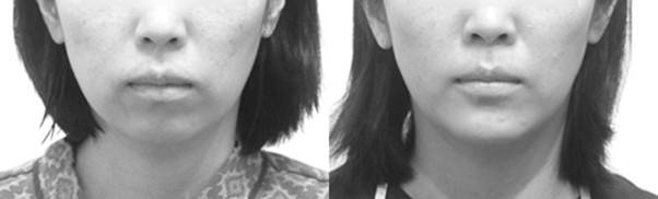 인중이 길고 입꼬리가 떨어진 것이 아니라, 턱 끝이 뒤로 빠진 상태입니다.