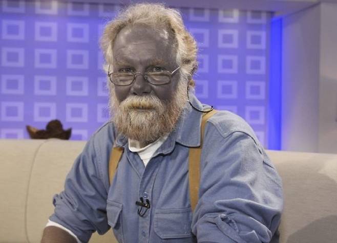 은피증은 2013년 미국에서 사는 60대 남성 폴 카라슨이 ‘파파 스머프’라고 불린다며 알려졌다./사진=미국 NBC ‘TODAY’