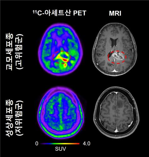 연구 결과도 교모세포종 환자와 성상세포종 환자에서 관찰되는 11C-아세트산 PET와 MRI 이미지 [IBS 제공. 재판매 및 DB금지]