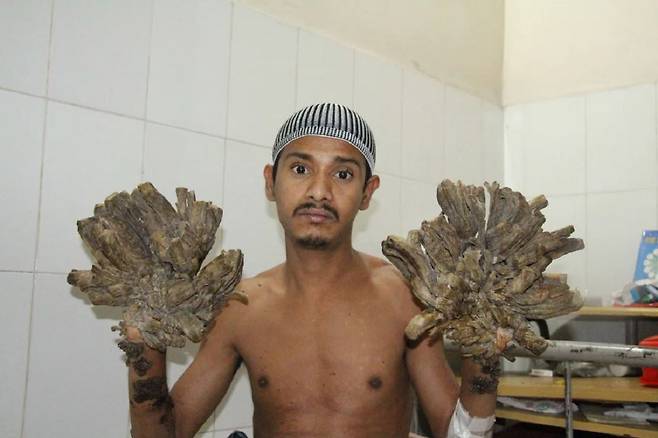 아불 바잔달은 우취성 표피이상증 때문에 손이 점점 나무처럼 변했다./사진=CNN(