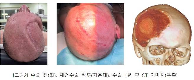 티앤알바이오팹이 참여한 우크라이나 환자 두개골재건술 전과 후. /사진제공=티앤알바이오팹