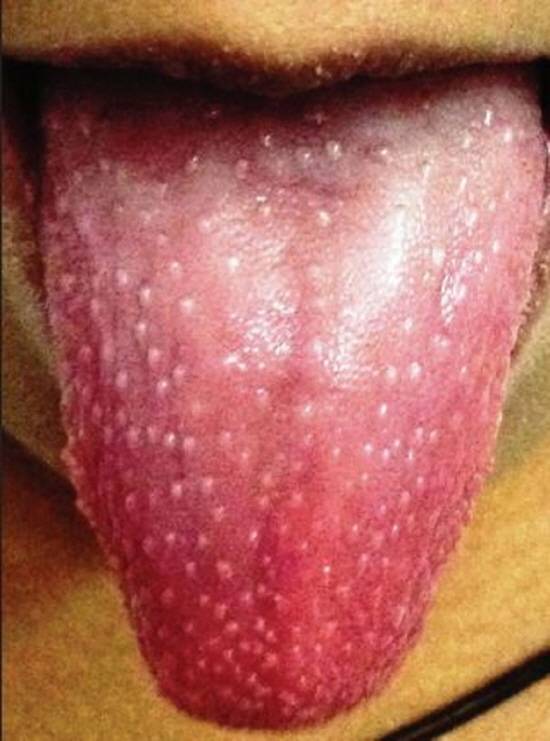 혀가 딸기 혀처럼 변했다면 음식 알레르기 혹은 비타민B12 결핍이 원인일 수 있다./사진= Indian Journal of Dermatology, Venereology and Leprology