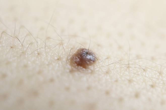 점에서 유독 털이 길게 자라는 이유는 털의 생장주기가 정상적인 세포와 다르게 작용하기 때문이다./사진=게티이미지뱅크