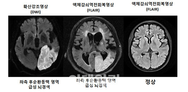 뇌 MRI 영상