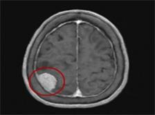 뇌종양 <사진: 서울아산병원>