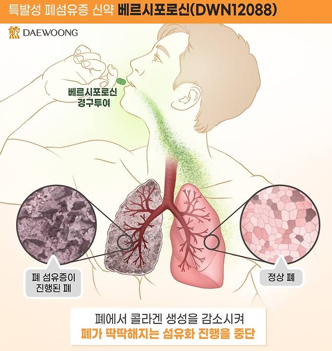 신약으로 개발 중인 베르시포로신 작용 원리/사진=대웅제약