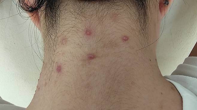 목 뒤에만 퍼져있는 여드름은 모낭염일 가능성이 높다. 모낭염은 머리카락, 목걸이, 스카프, 샴푸, 린스 등 물리적·화학적 자극과 세균 감염으로 모낭(털구멍)에 염증이 생기는 질환이다. [사진=게티이미지뱅크]