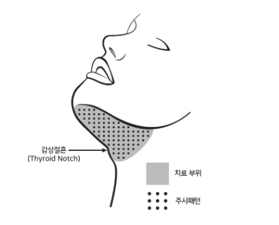 지방분해주사 부위(출처=의약품안전나라)