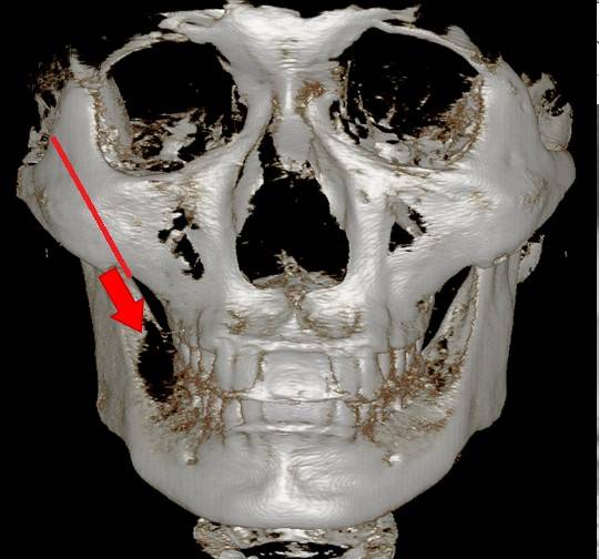 입안으로 절개하여 광대뼈를 밀어넣으면 뼈에 부착된 볼살은 처지는 사선 방향으로 움직이기 쉽습니다.