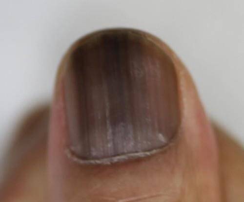 흑색종 / 사진=연합뉴스